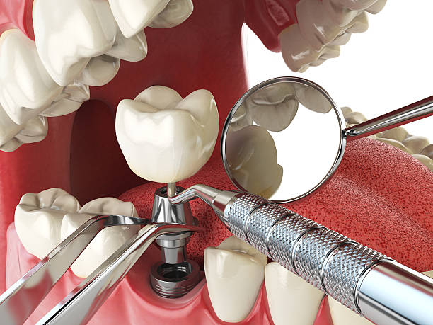 Best Knocked-Out Tooth (Avulsed Tooth) Treatment in Maybrook, NY